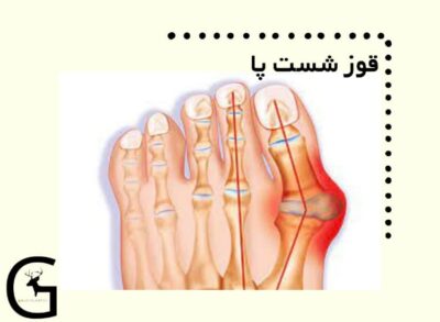 قوز شست پا یکی از مشکلات اساسی بر اثر تنگ بودن کفش است که بوجود آمده است